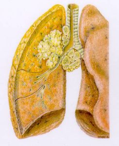 Carcinoma Polmonare da fumo
